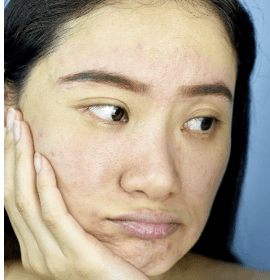 Spider Veins Geelong
