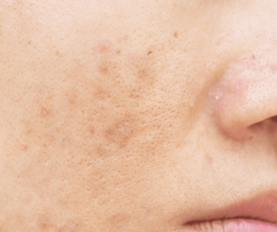 Spider Veins Geelong
