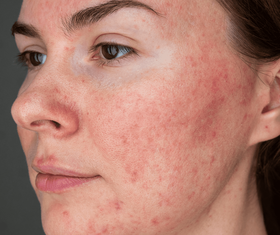 Spider Veins Geelong
