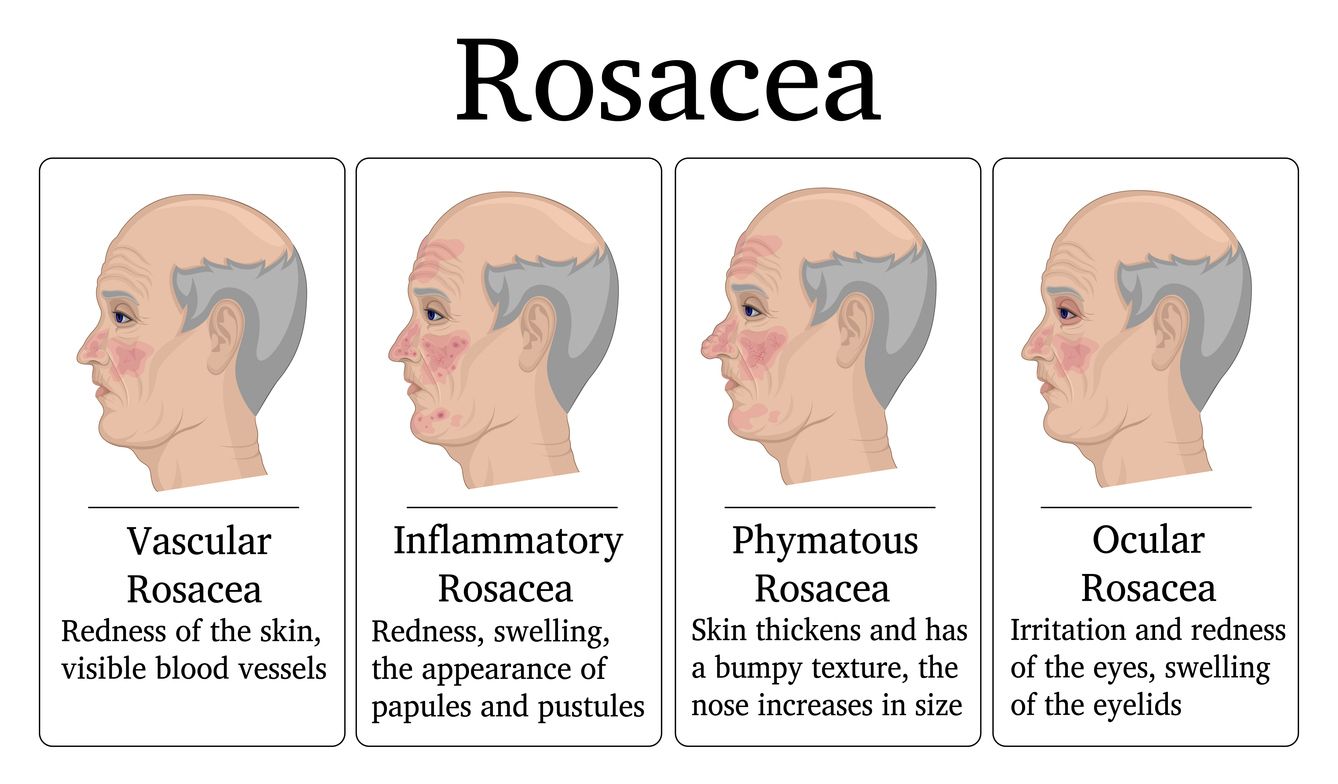 Rosacea treatment Geelong
