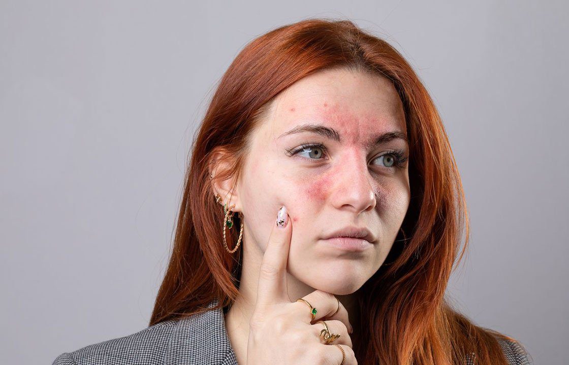 Understanding Rosacea
