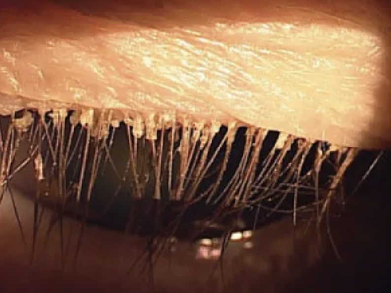 Demodex mites in eyelashes